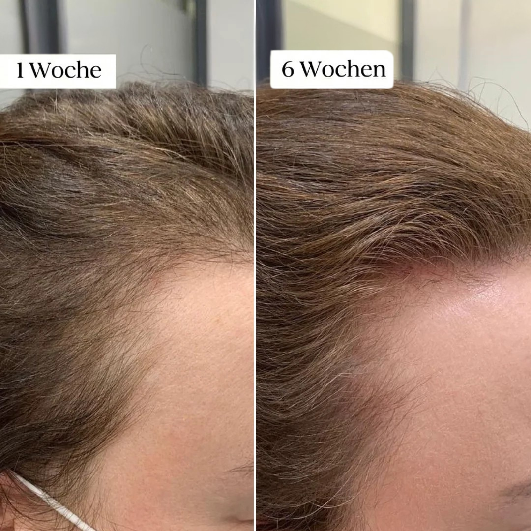 Glow Drops™ Mikronadel Pflege System